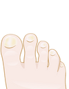 Zanokcica czyli zapalenie korzeni paznokci - dobre rady na leczenie