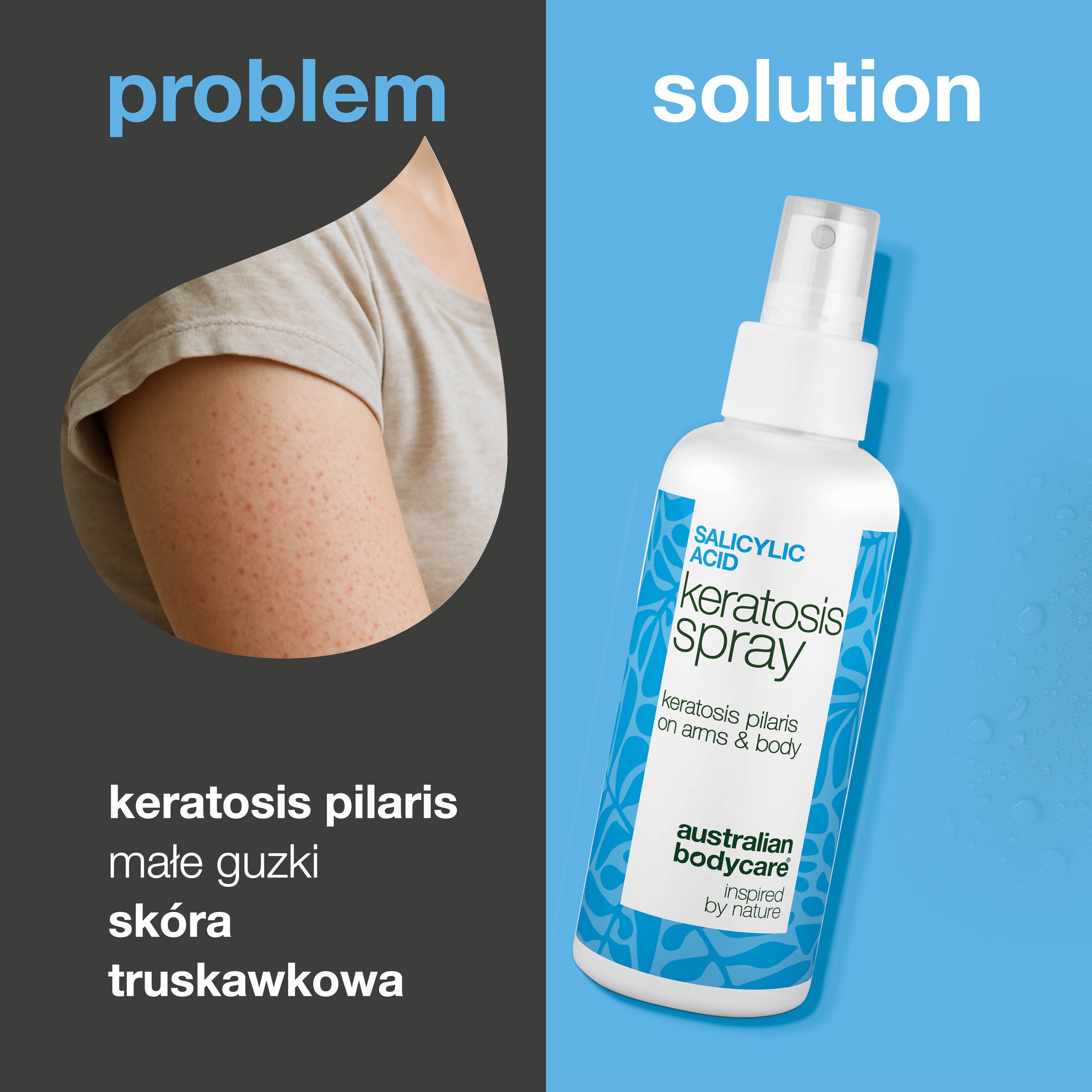 Spray na keratosis pilaris i szorstką skórę z krostkami — rogowacenie mieszkowe spray wygładza szorstką skórę i zmniejsza krostki. Zawiera kwas salicylowy dla delikatnego złuszczania.