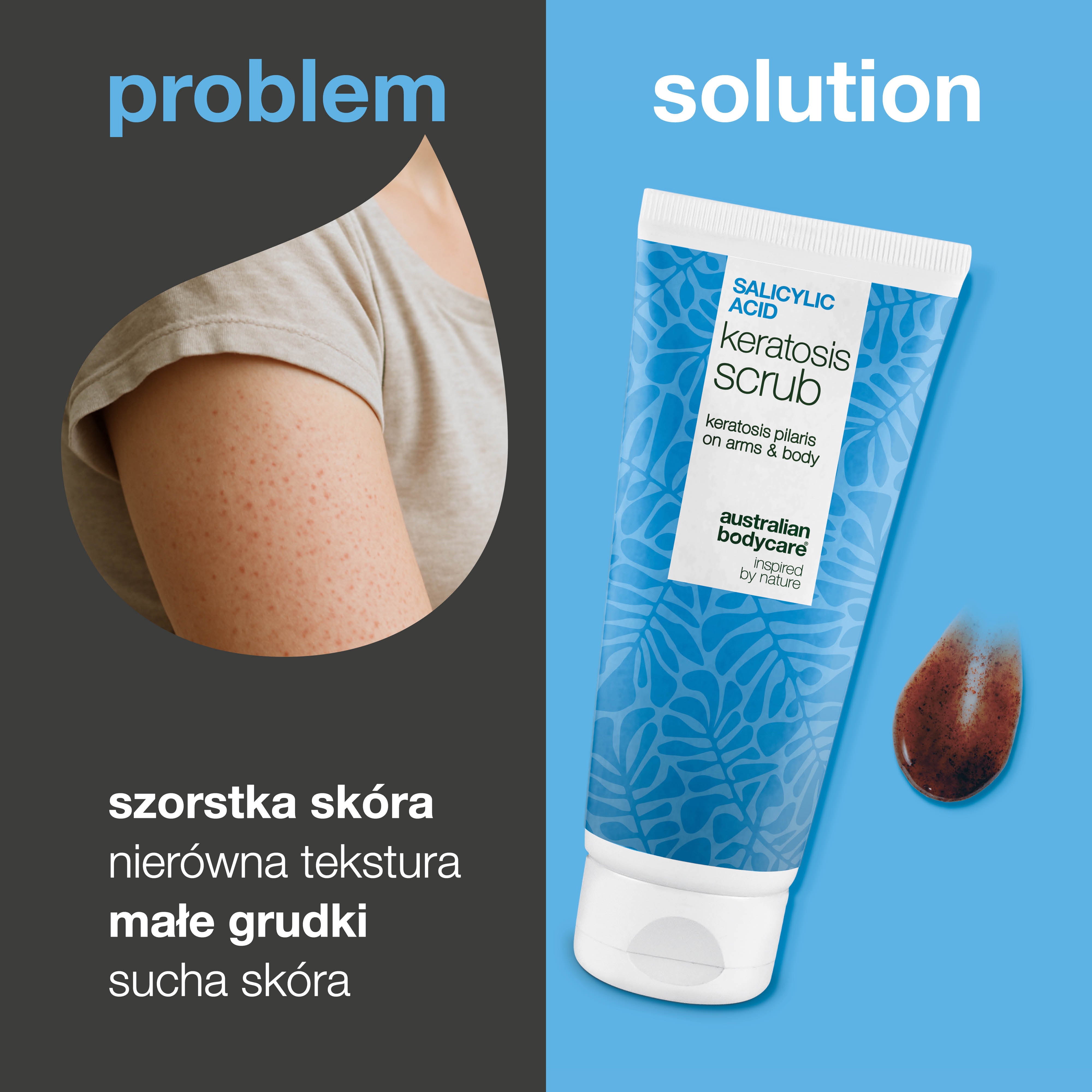 Peeling do ciała Keratosis Pilaris usuwa martwy naskórek i redukuje grudki. Wygładza skórę dzięki kwasowi salicylowemu, glicerynie i alantoinie.