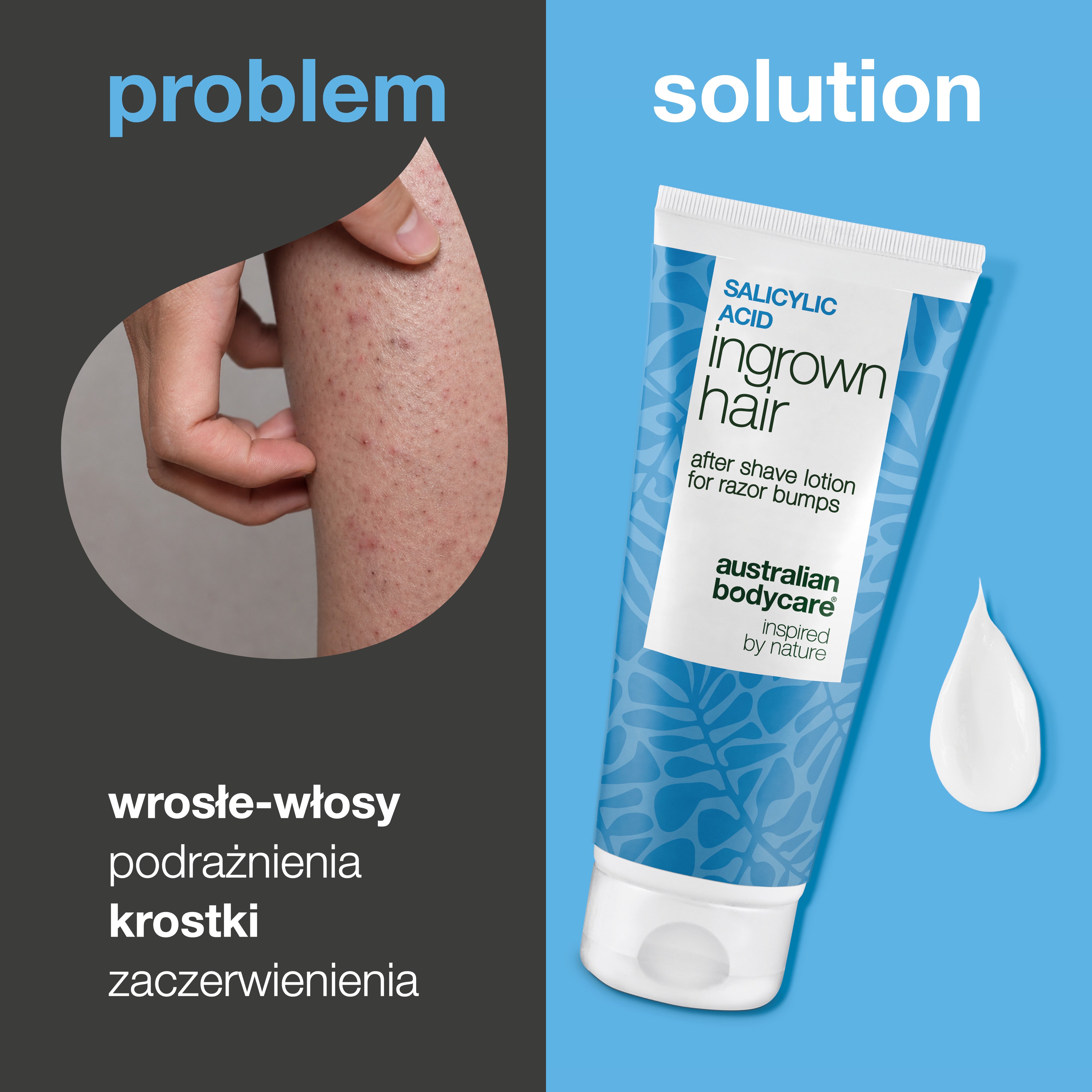 Balsam po goleniu z kwasem salicylowym na wrastające włoski, czerwone krostki i podrażnienia po goleniu. Produkt pokazano obok skóry z widocznymi czerwonymi krostkami i wrastającymi włoskami.