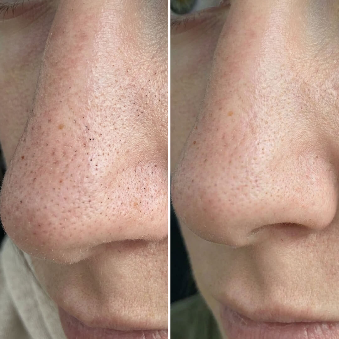 Zestaw na zaskórniki i zatkane pory z kwasem salicylowym – dogłębne oczyszczanie dla gładkiej skóry