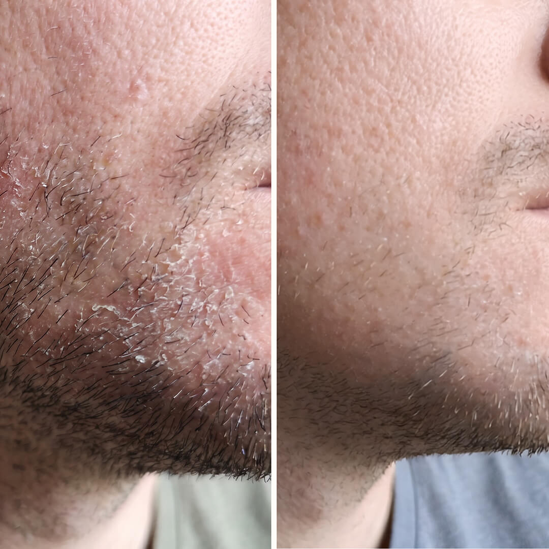 Serum z kwasem salicylowym – Na łupież na twarzy i w brodzie — Skuteczne serum na łupież na twarzy i w brodzie. Kwas salicylowy szybko usuwa łuski i zaczerwienienia, przywracając skórze zdrową równowagę.