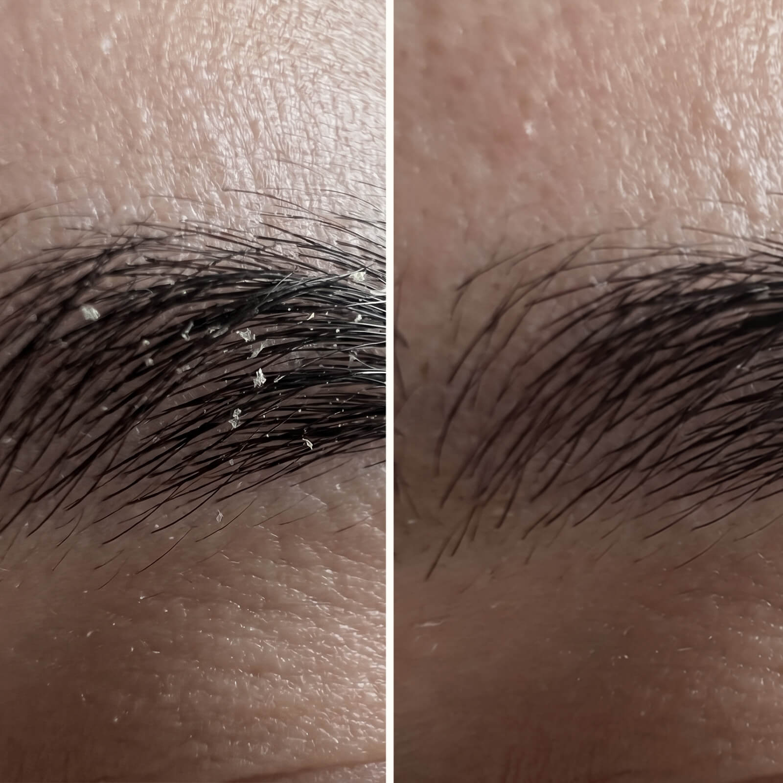 Serum z kwasem salicylowym – Na łupież na twarzy i w brodzie — Skuteczne serum na łupież na twarzy i w brodzie. Kwas salicylowy szybko usuwa łuski i zaczerwienienia, przywracając skórze zdrową równowagę.