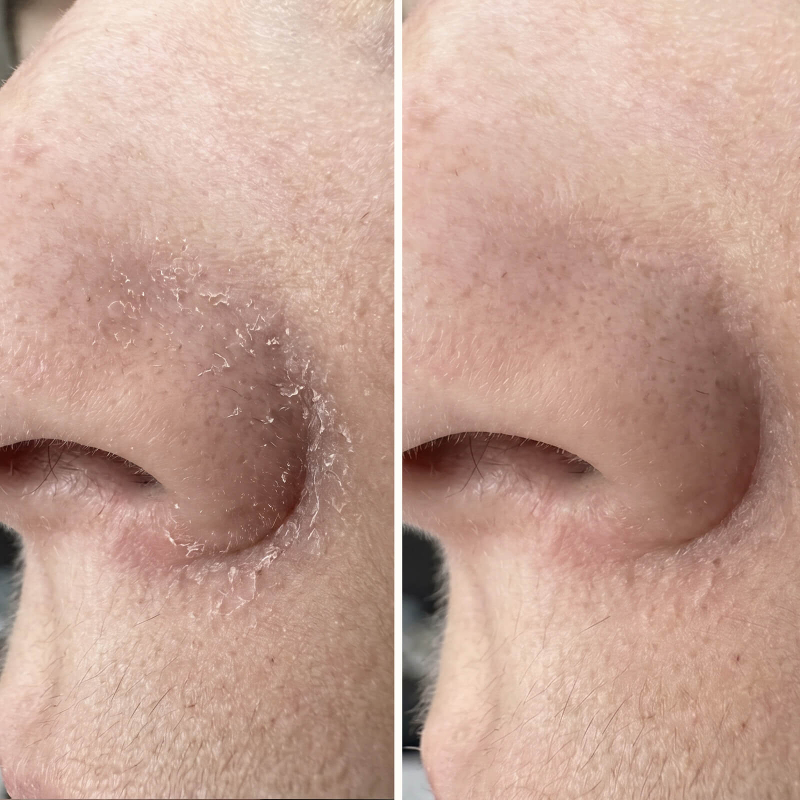 Serum z kwasem salicylowym – Na łupież na twarzy i w brodzie — Skuteczne serum na łupież na twarzy i w brodzie. Kwas salicylowy szybko usuwa łuski i zaczerwienienia, przywracając skórze zdrową równowagę.