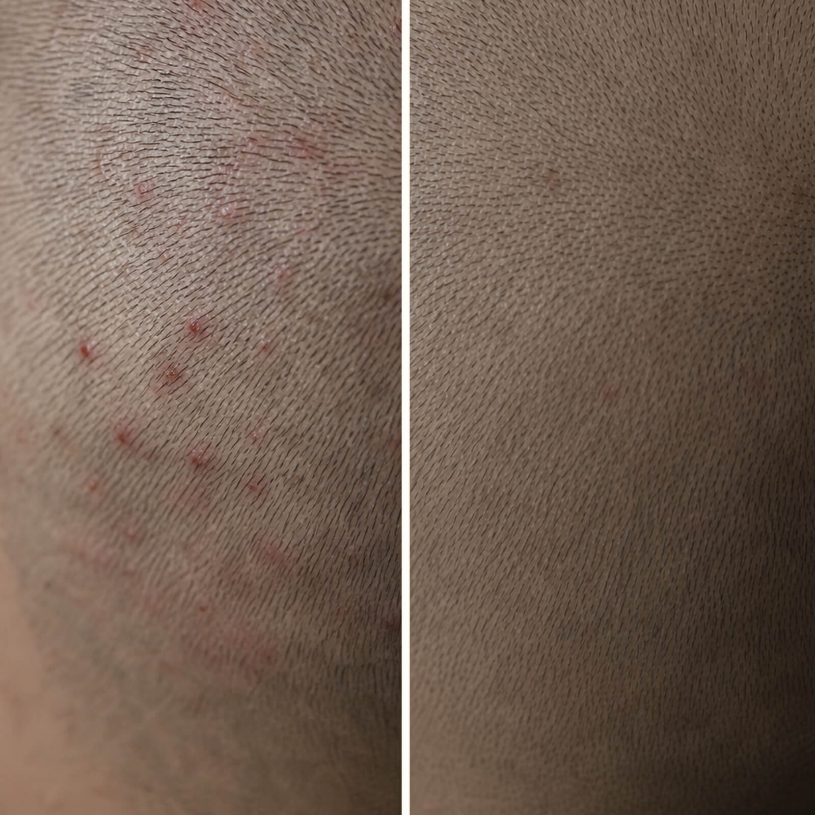 Żel z Kwasem Salicylowym na krosty i świąd głowy — Zatrzymaj krosty na skórze głowy! Kwas Salicylowy złuszcza pory, redukuje sebum i koi bolesne zaczerwienienia skutecznie i naturalnie.