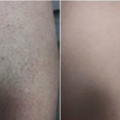 Efekt Aleny po 2 tygodniach z zestawem keratosis pilaris