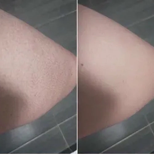 Keratosis pilaris przed i po – gładsza skóra Aleny po 2 tygodniach
