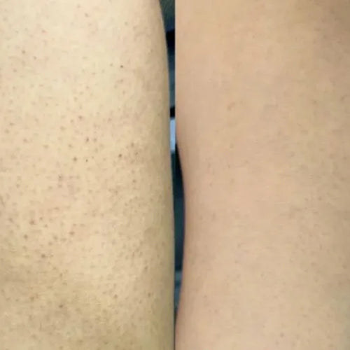 Efekt Isabell z zestawem keratosis pilaris – mniej grudek na udach