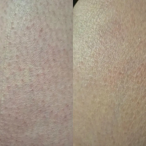 Zbliżenie skóry po leczeniu keratosis pilaris – efekt Carolin