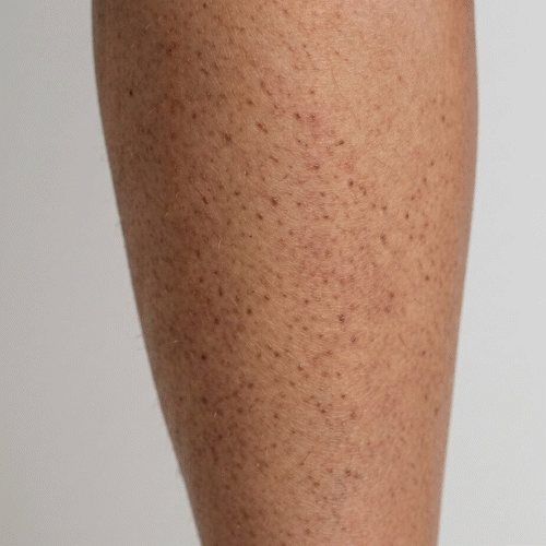 Zbliżenie keratosis pilaris – drobne szorstkie grudki na ramionach