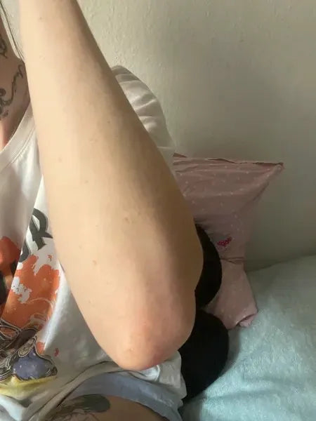 Efekt klienta keratosis pilaris – Lisa A.