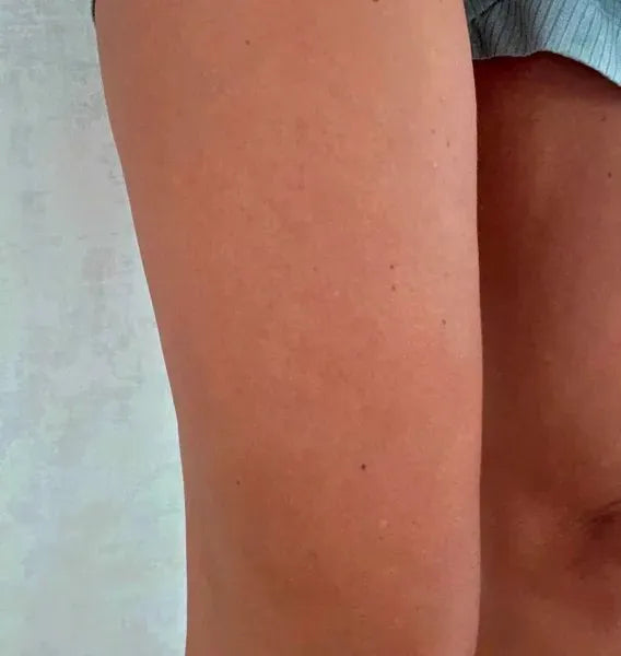 Efekt klienta keratosis pilaris – Sarah S.