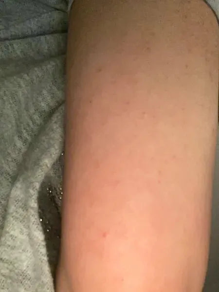Efekt klienta keratosis pilaris – Shaian H. używa Australian Bodycare