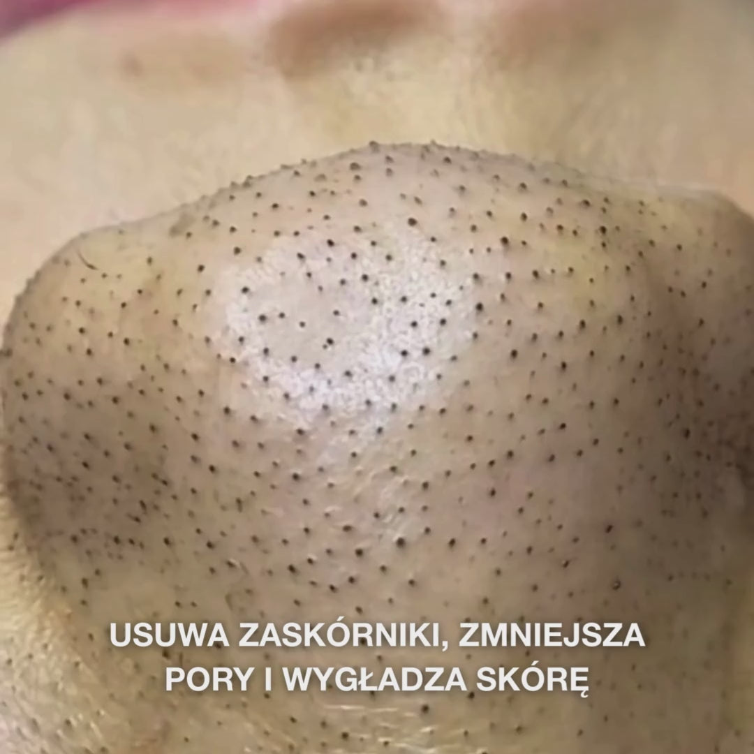 Salicylic Acid toner redukuje niedoskonałości, zaskórniki i przetłuszczanie skóry. Działa skutecznie i delikatnie. Salicylic Acid od Australian Bodycare.