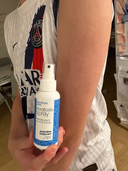 Efekt klienta keratosis pilaris – 70% mniej grudek po 3 tygodniach